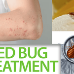 Bed Bugs removal